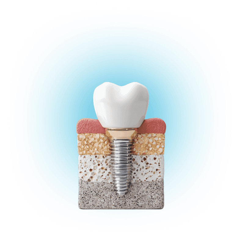 Имплантация