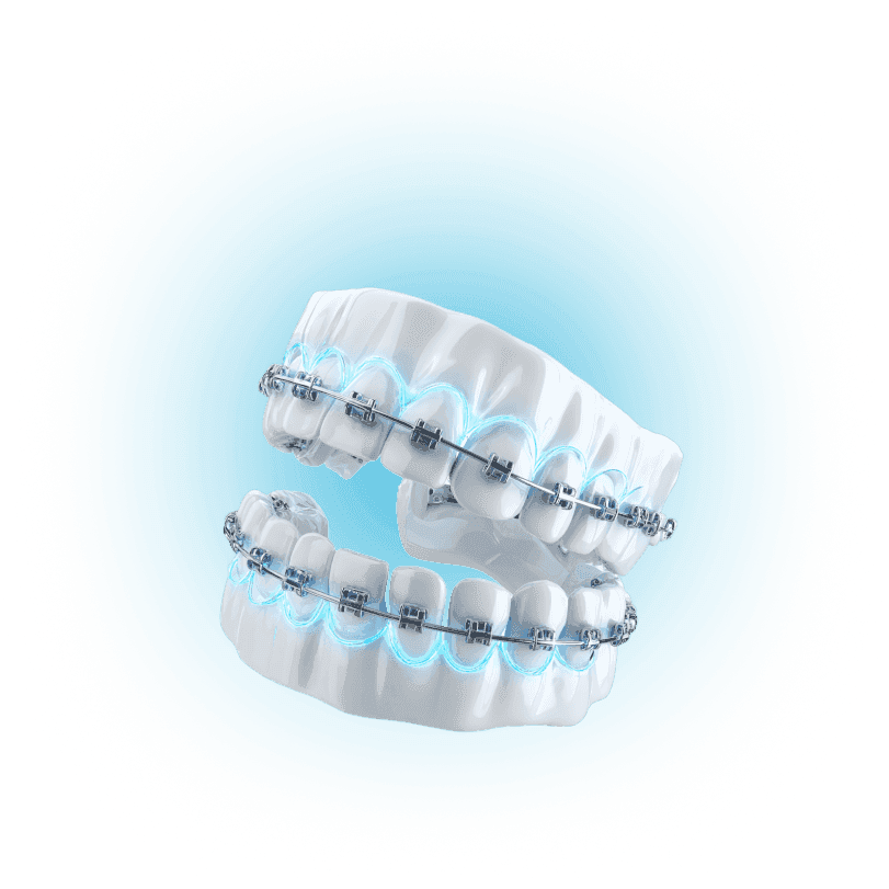 Установка брекетов